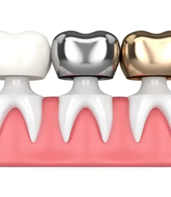 dental-crowns-everything-you-need-to-know