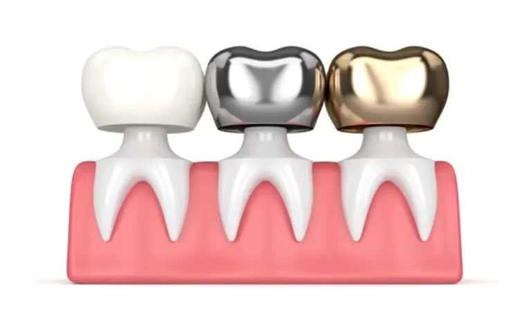 dental-crowns-everything-you-need-to-know