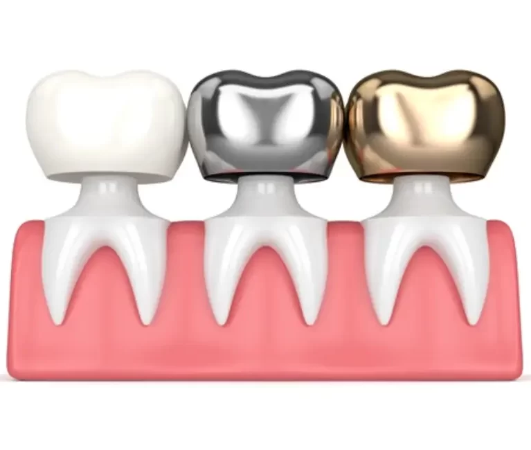 dental-crowns-everything-you-need-to-know