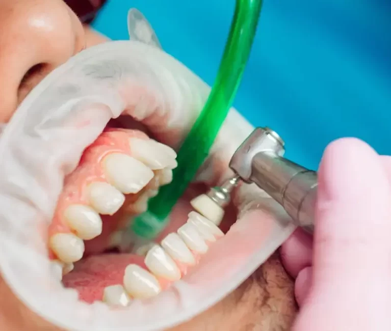 teeth-cleaning-importance-procedure-and-tips-for-a-healthy-smile