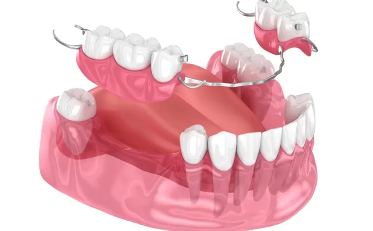 what-are-fixed-partial-dentures