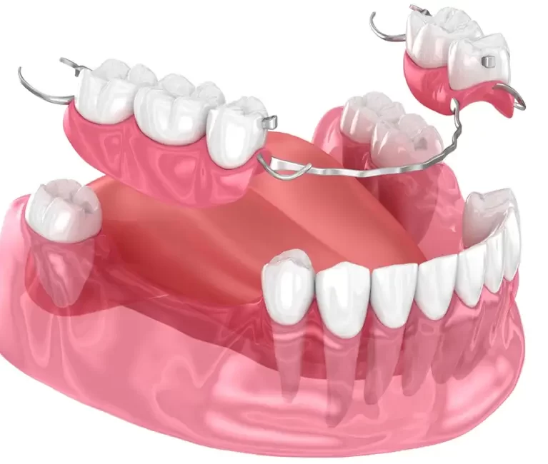 what-are-fixed-partial-dentures