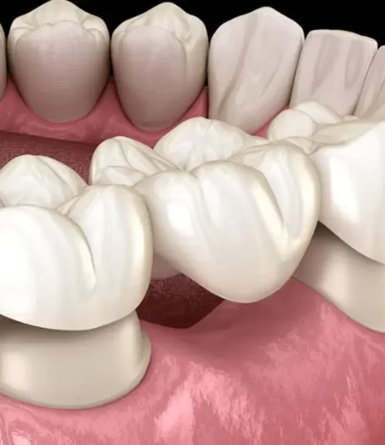 what-to-expect-during-a-dental-crown-procedure