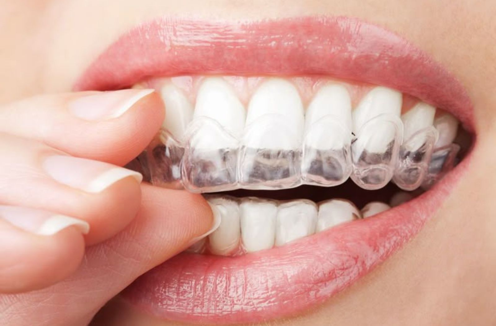 Invisalign treatment at 4 Square Dentistry Chennai