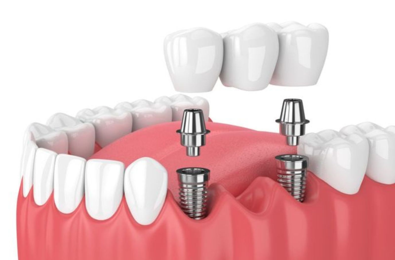 Dental Crowns and Bridges in Madipakkam