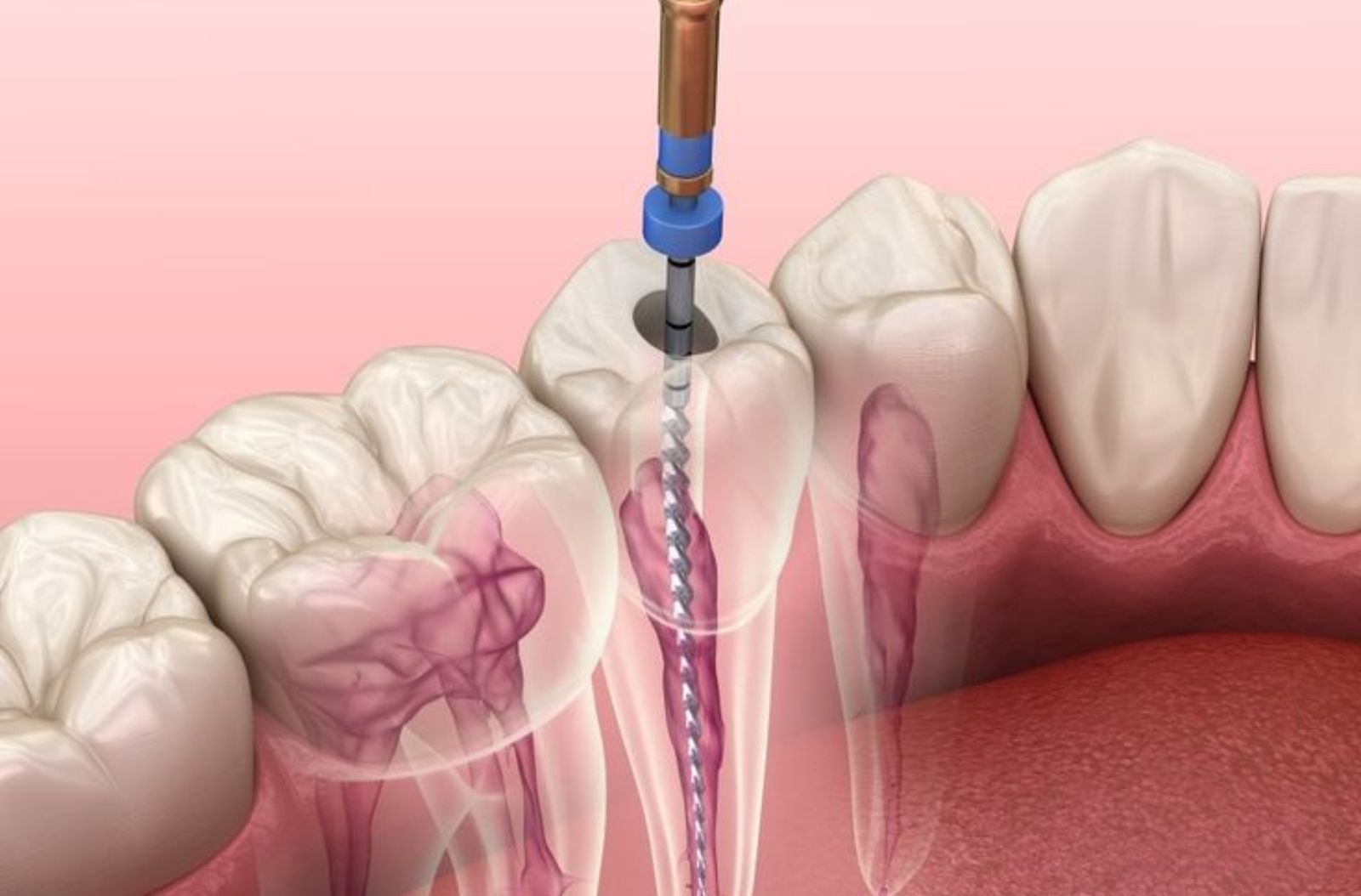 Painless Root Canal Treatment in Chennai
