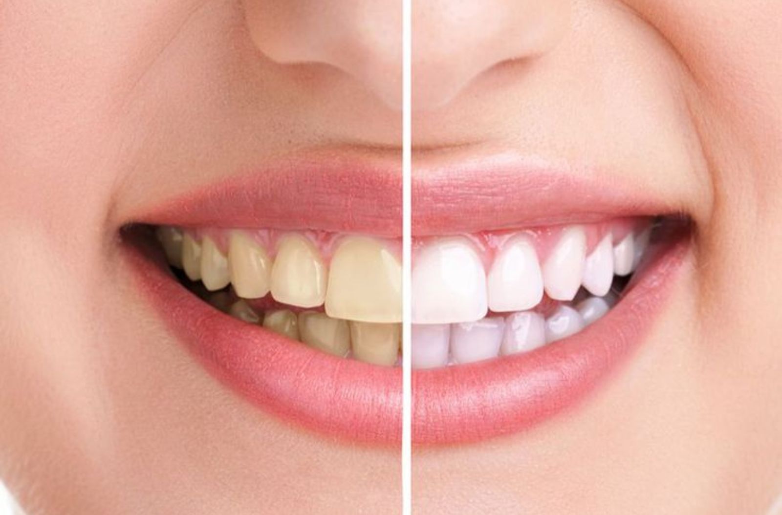 Teeth Whitening in Thoraipakkam