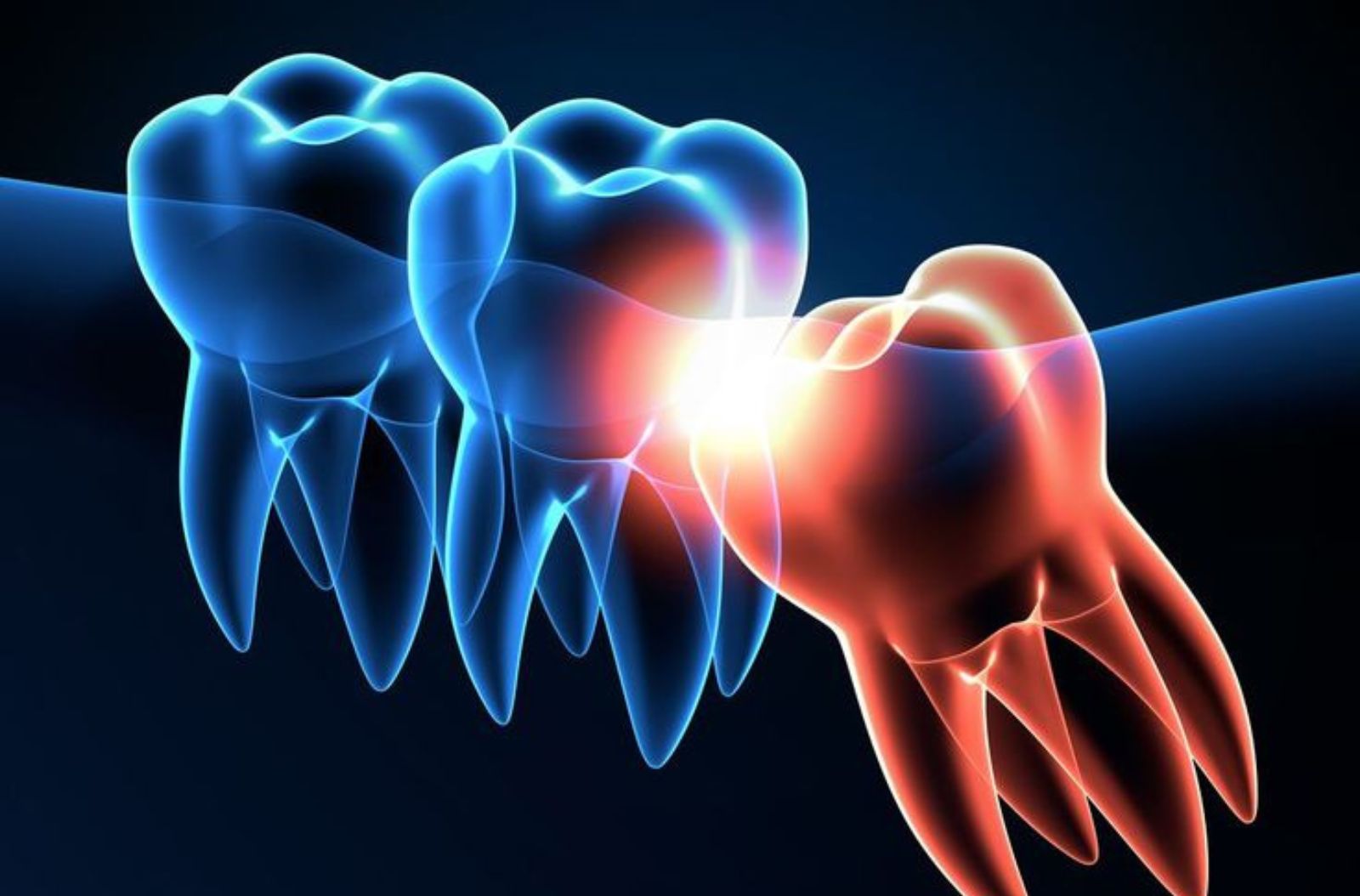 Wisdom Tooth Removal in Gowrivakkam