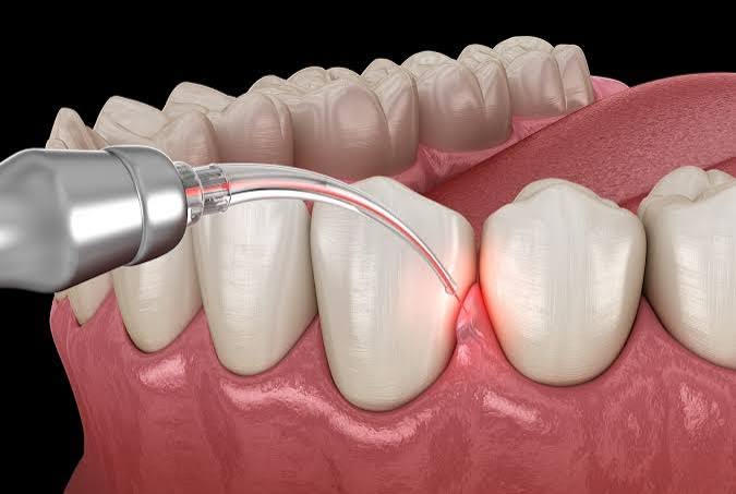 Laser Dentistry in Chennai