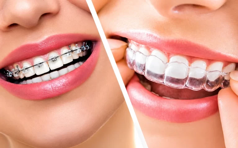 Invisalign vs Braces