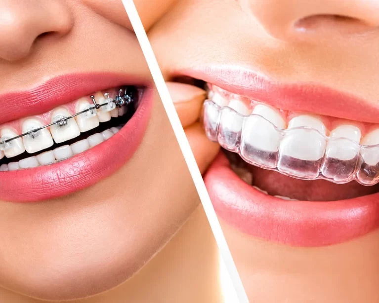 Invisalign vs Braces