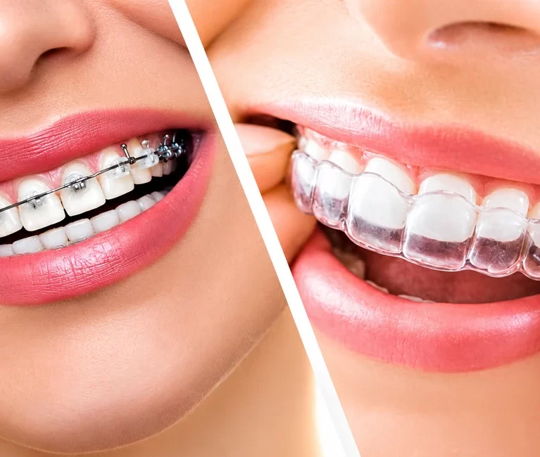 Invisalign vs Braces