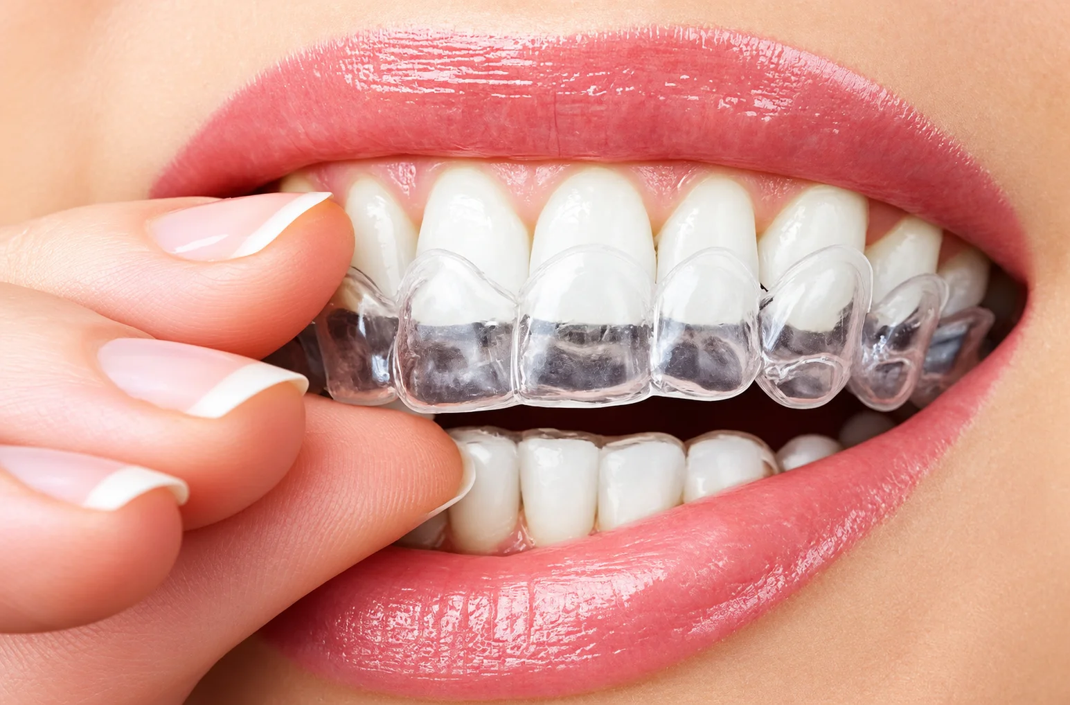 Clear aligners treatment at 4 Squares Dentistry Chennai