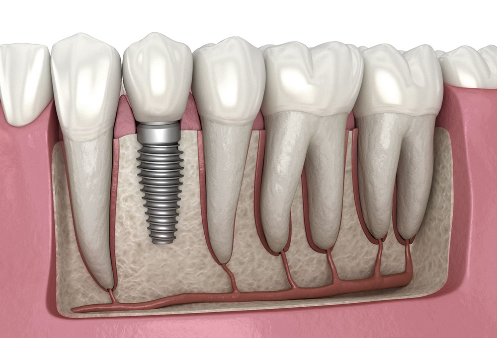 What Are Dental Implants